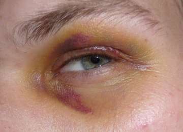 Masnica na oku - što je i kako ju liječiti?