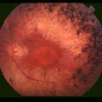 https://www.dioptrija.hr/bolesti-oka/istrazivaci-otkrili-tehniku-za-poboljsanje-stanja-retinitis-pigmentosa