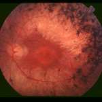 https://www.dioptrija.hr/bolesti-oka/retinitis-pigmentosa-rp-sto-se-lijeci