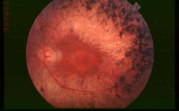 Istraživači otkrili tehniku za poboljšanje stanja retinitis pigmentosa