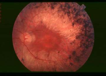 Istraživači otkrili tehniku za poboljšanje stanja retinitis pigmentosa