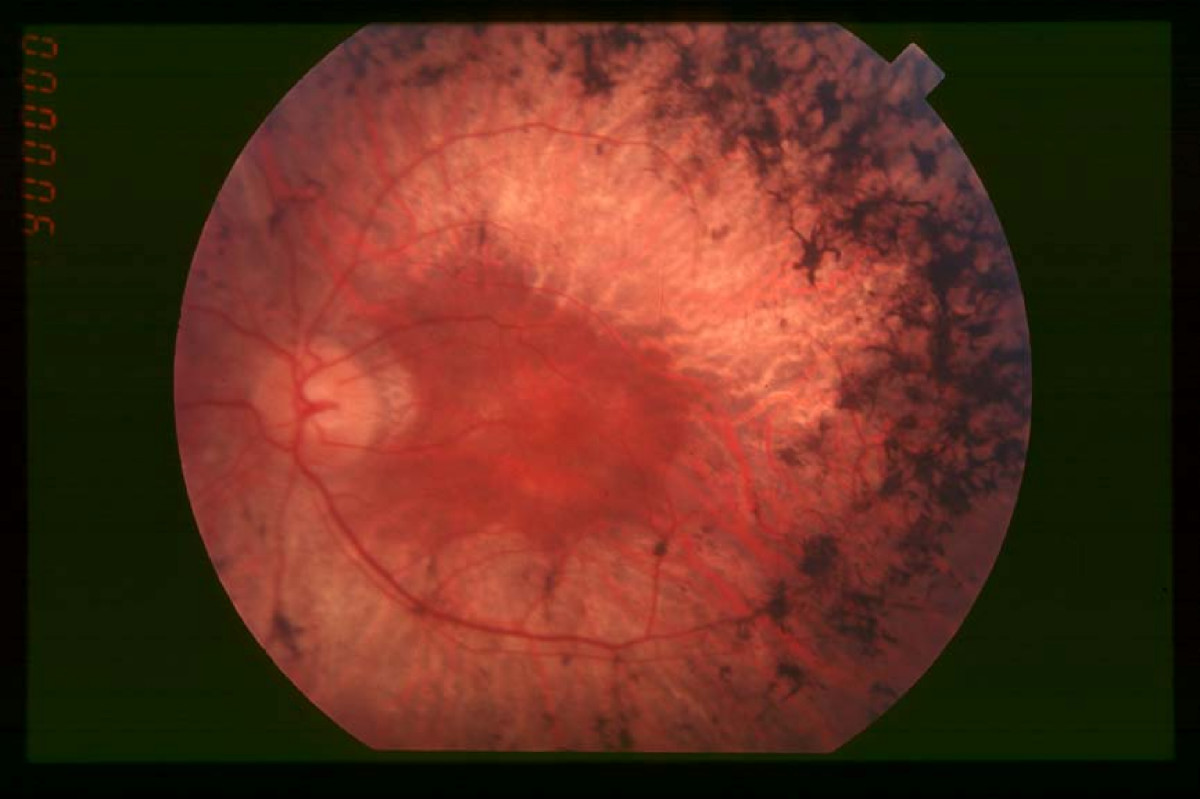 Istraživači otkrili tehniku za poboljšanje stanja retinitis pigmentosa