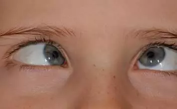 Što je strabizam i kako se liječi?