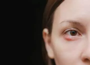 Ječmenac na oku– koji su uzroci, simptomi i liječenje?