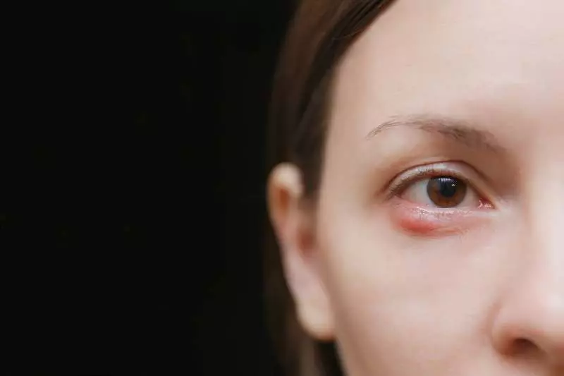 Ječmenac na oku: koji su uzroci, simptomi i liječenje! | Dioptrija.hr