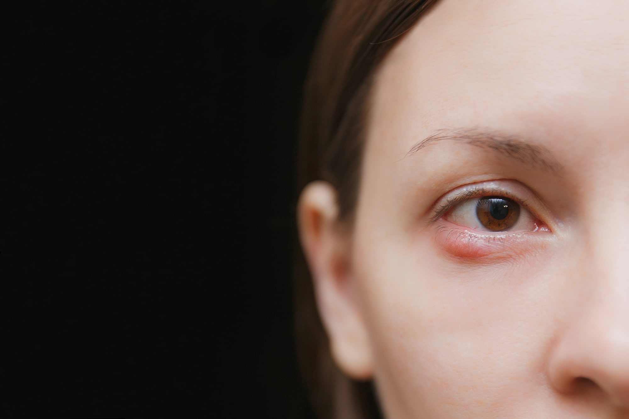 Ječmenac na oku– koji su uzroci, simptomi i liječenje?
