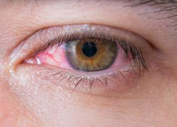 Crvene (krvave) oči - što ih uzrokuje i kako ih se riješiti?