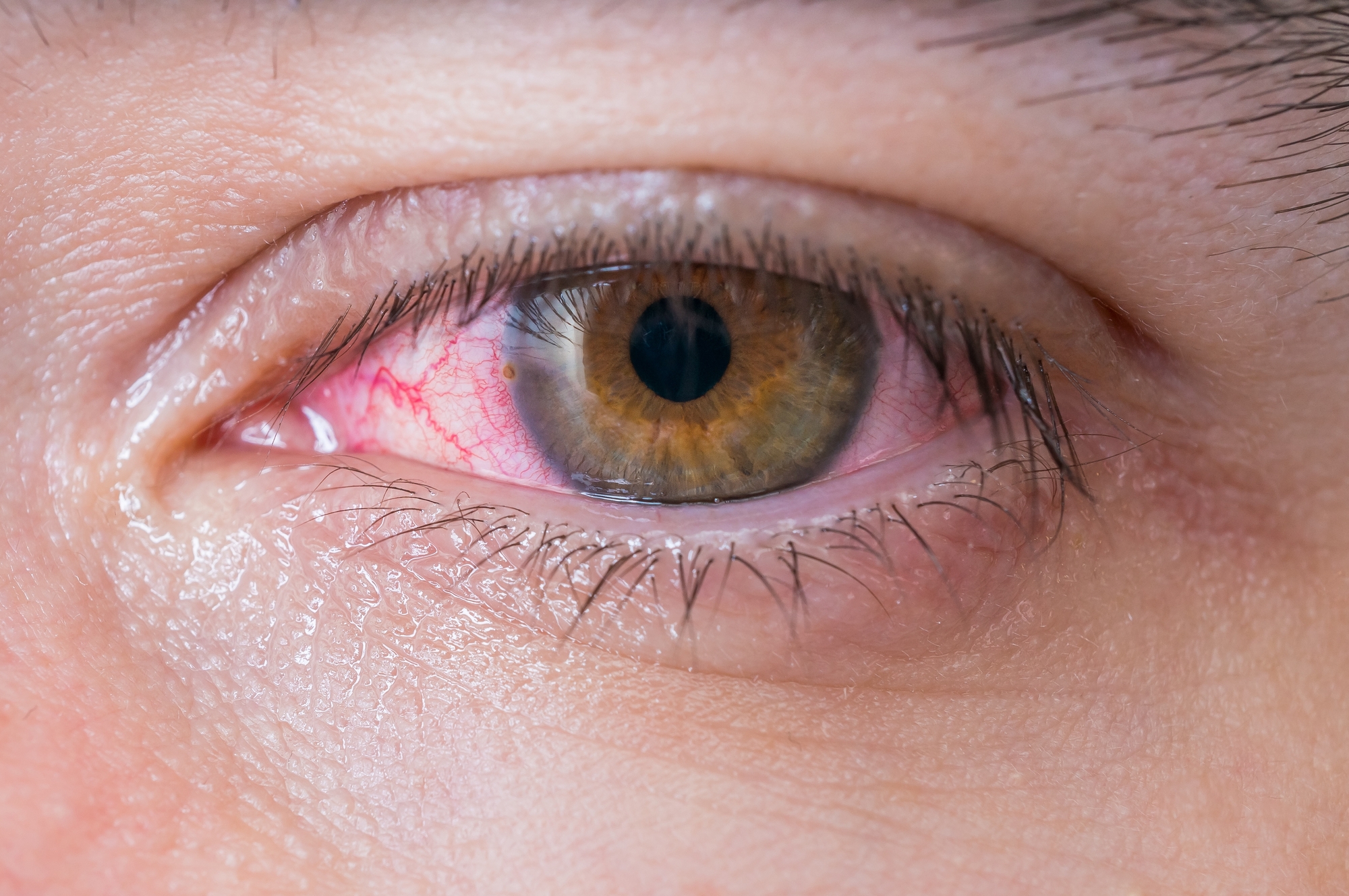 Crvene (krvave) oči - što ih uzrokuje i kako ih se riješiti?