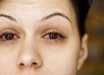 Konjuktivitis - vrste, uzroci, simptomi i liječenje