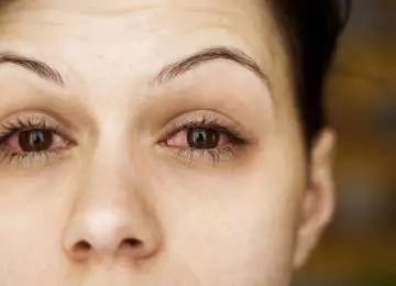 Konjuktivitis - vrste, uzroci, simptomi i liječenje