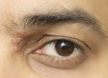 Herpes na oku - simptomi, liječenje i prevencija