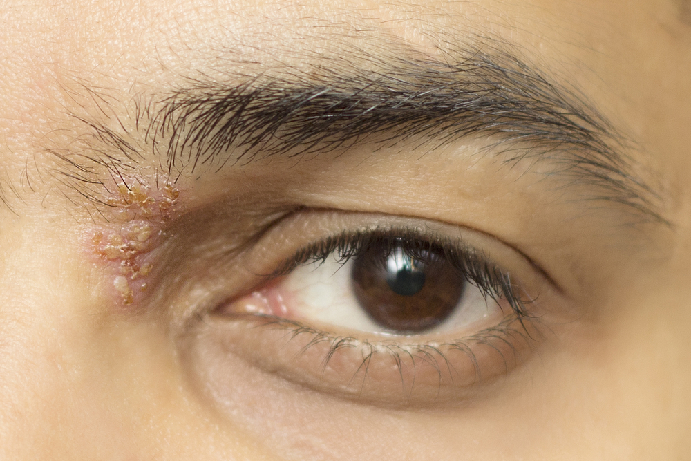 Herpes na oku - simptomi, liječenje i prevencija