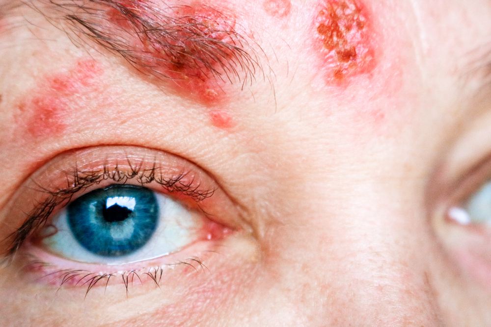 Herpes oka - kako izgleda i koji su uzroci, simptomi i liječenje