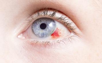 Pucanje kapilara u oku - što činiti kada nam je krvavo oko?