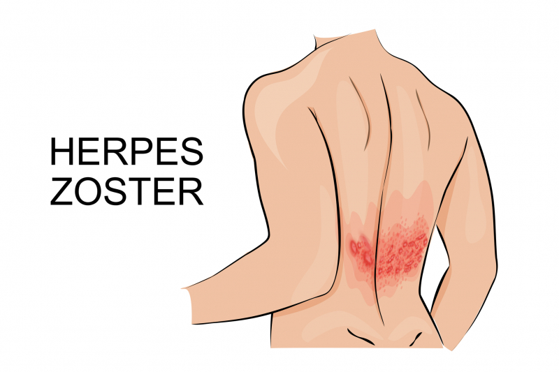 Herpes zoster dioptrija