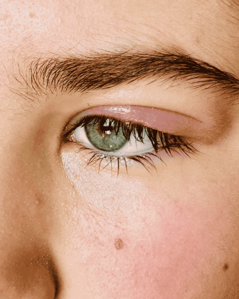 Swollen eyelids natecen kapak dioptrija