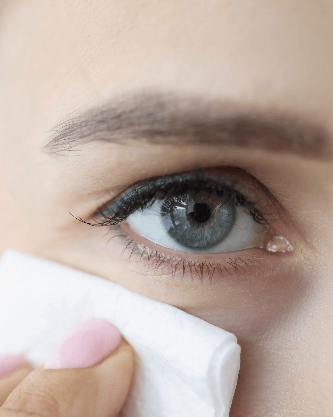 Natečeni kapci ujutro: zašto se budimo s otečenim očima i kako to spriječiti