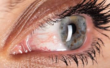 Konjunktivitis: simptomi, uzroci, liječenje i kada se javiti oftalmologu