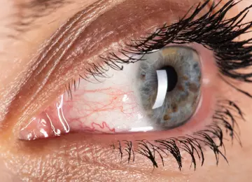 Konjunktivitis: simptomi, uzroci, liječenje i kada se javiti oftalmologu