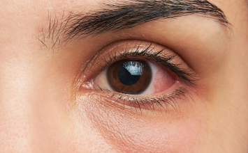 Infekcija oka: najčešće vrste, simptomi i kada potražiti pomoć!