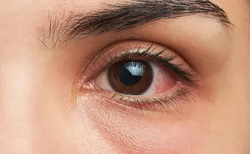 Infekcija oka: najčešće vrste, simptomi i kada potražiti pomoć!