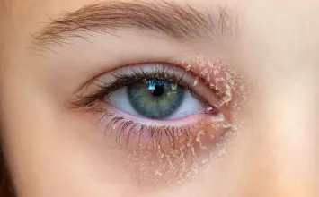 Blefaritis ili upala očnih vjeđa: simptomi, uzroci i liječenje